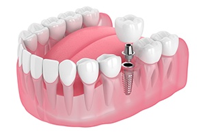Illustration of a single dental implant