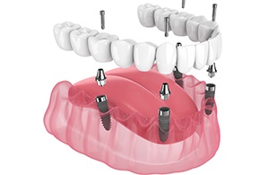 Illustration of an implant denture